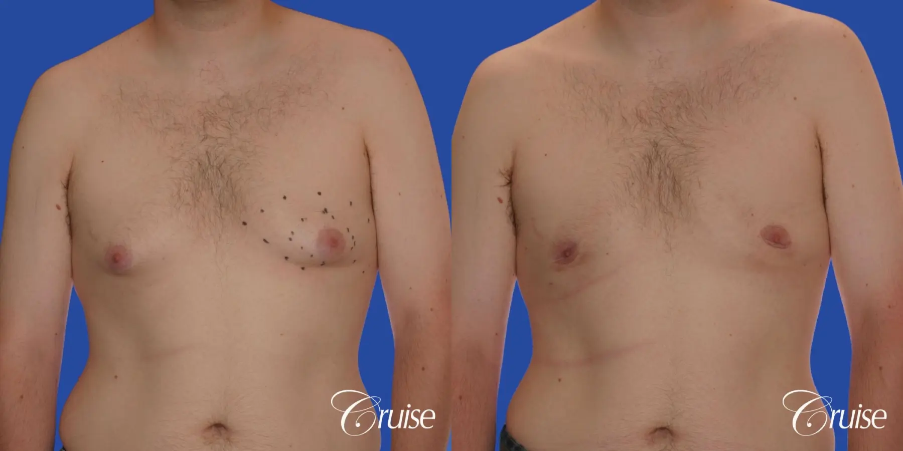 moderate gyne on 31 yr old male - Before and After 1