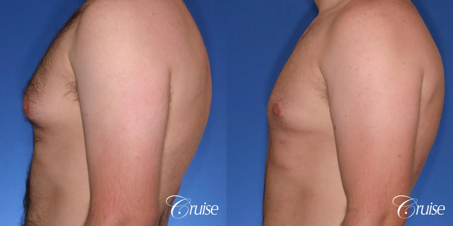 best Puffy nipple correction and gynecomastia on young adult - Before and After 2