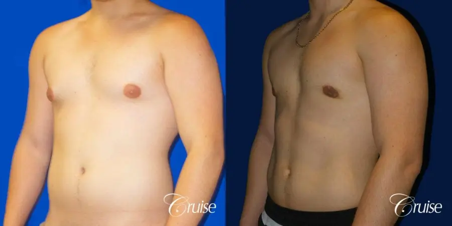 Best Gynecomastia surgeons Southern California - Before and After 3