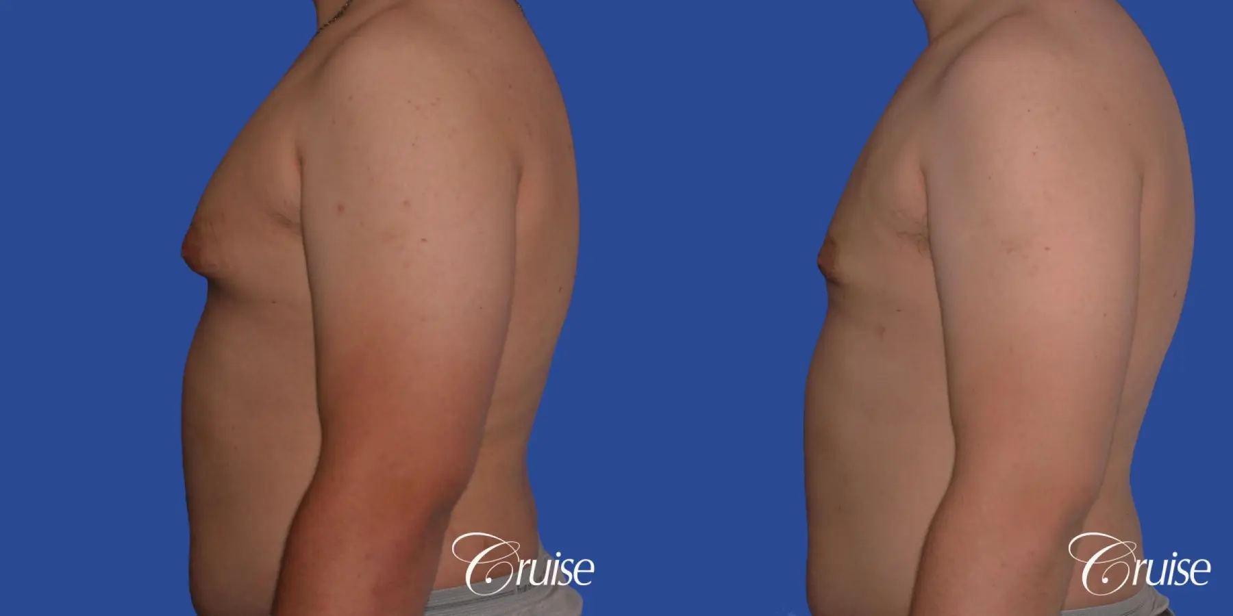 best scars for moderate gynecomastia - Before and After 2