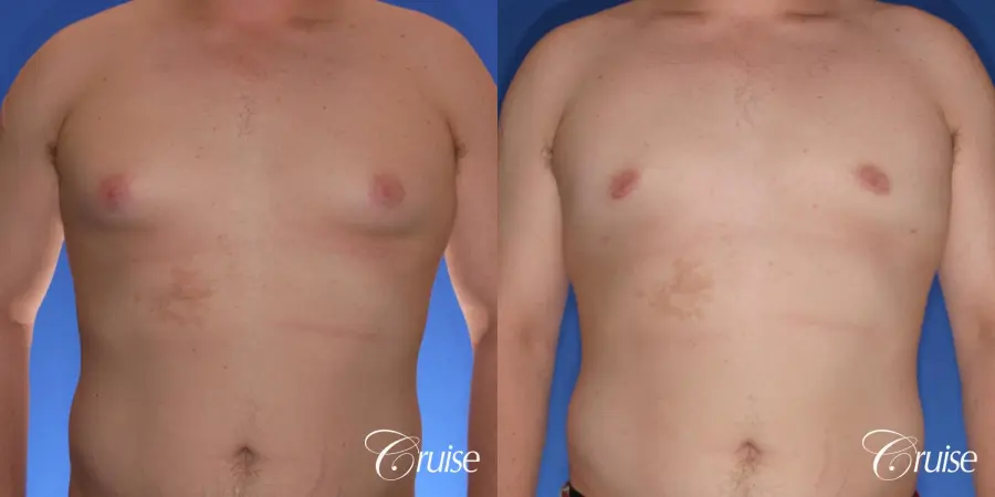 moderate gyne on teen with best pictures - Before and After 1