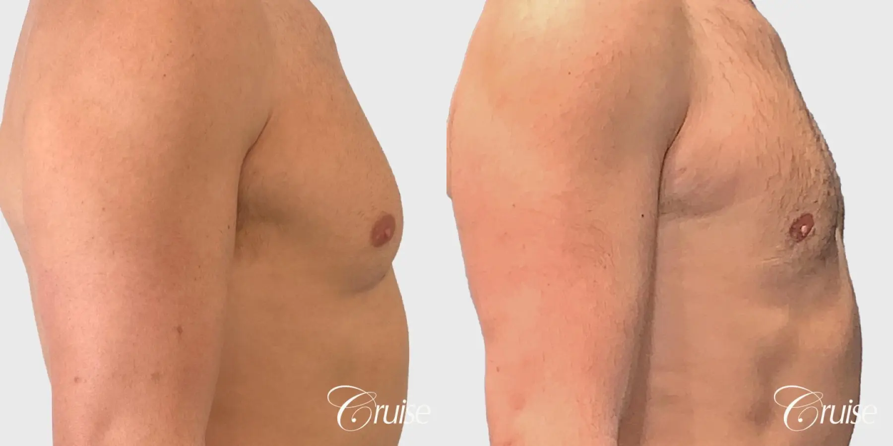 Gynecomastia Removal - Before and After 3