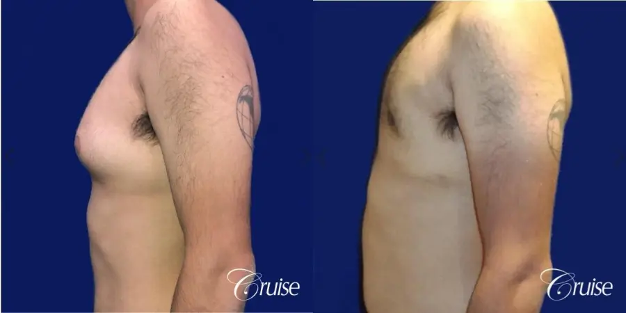 Moderate Gynecomastia Areola Incision - Before and After 2