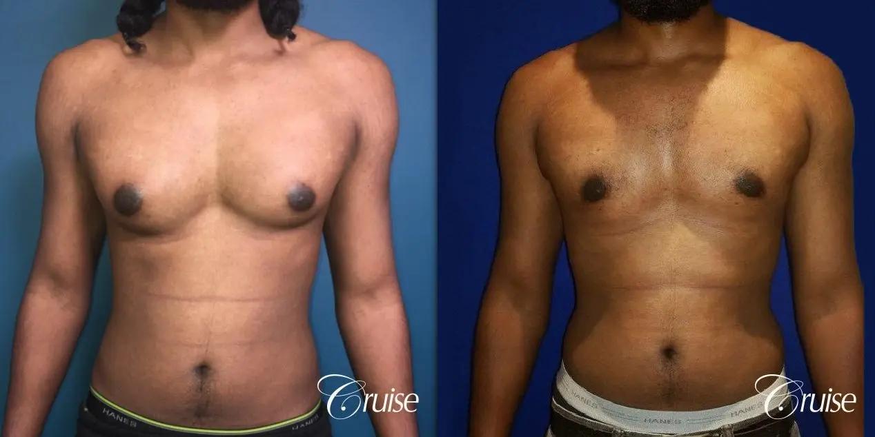 Type 3 Gynecomastia Gland Removal & Skin Tightening - Before and After 1