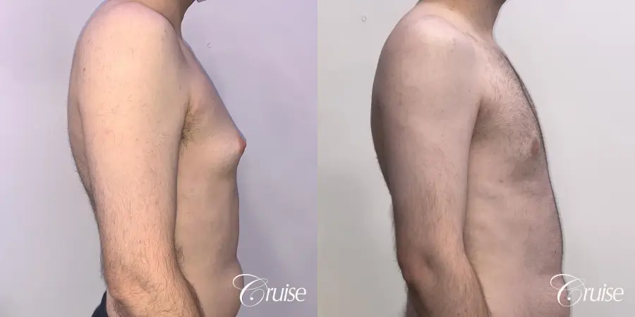 Gynecomastia: Patient 132 - Before and After 4