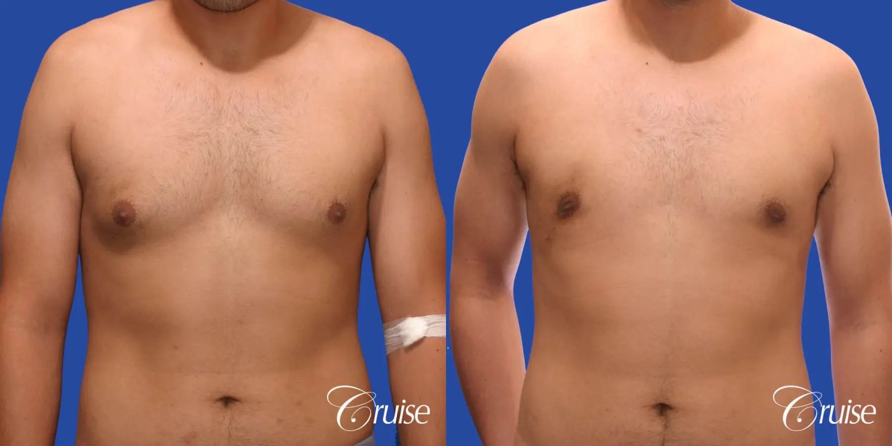 mild gynecomastia standard PA areola incision - Before and After 1