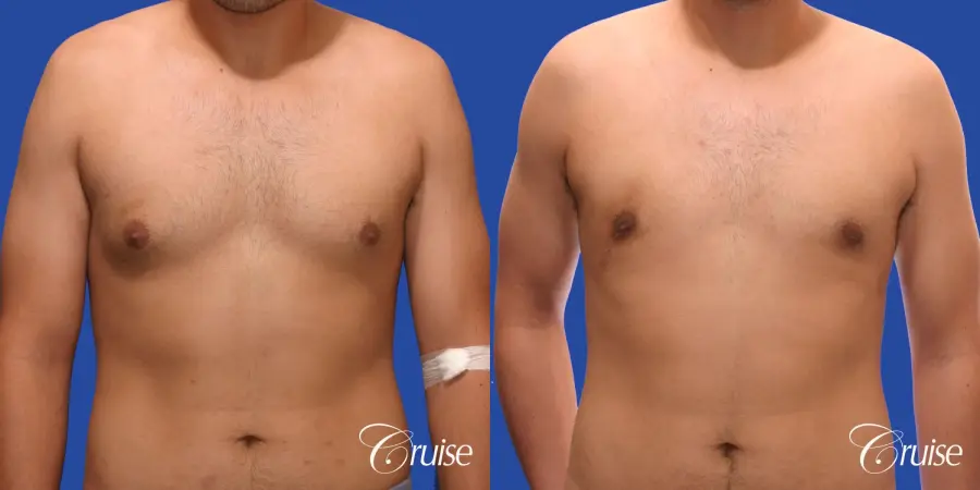 mild gynecomastia standard PA areola incision - Before and After 1