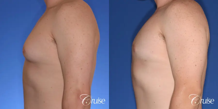 moderate gyne on teen with best pictures - Before and After 2