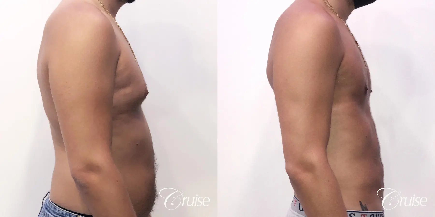 gynecomastia correction orange county - Before and After 4