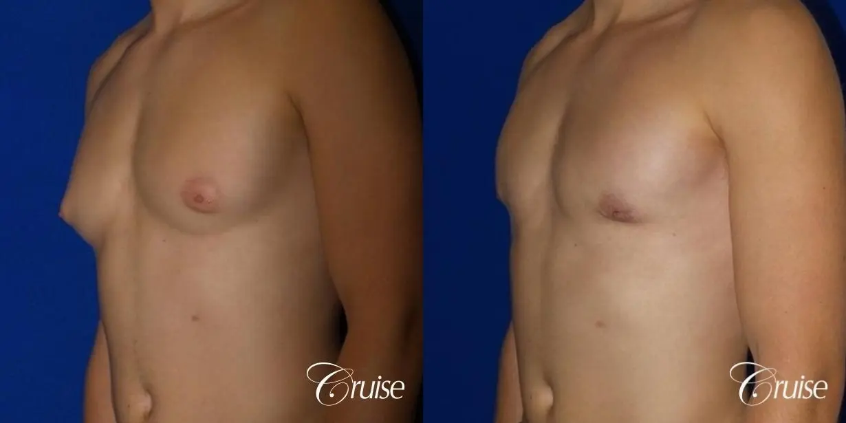 Mild Gynecomastia -Areola Incision - Before and After 2