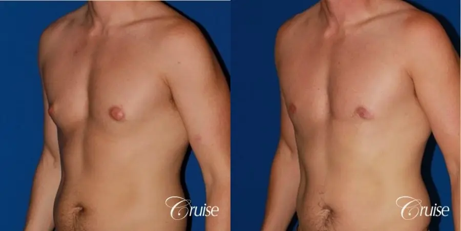 puffy nipple on 35 yr old male - Before and After 3