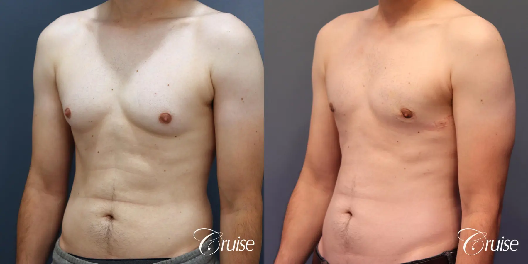 Gynecomastia: Patient 140 - Before and After 2