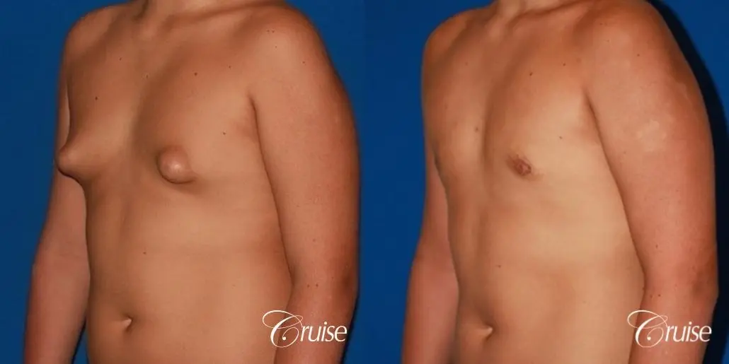 severe puffy nipple on teenager - Before and After 3