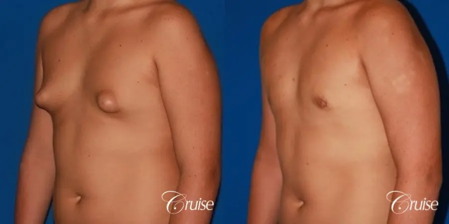 severe puffy nipple on teenager - Before and After 3
