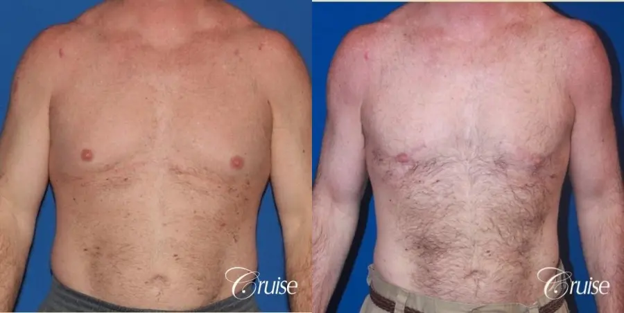 extended pa incision on gynecomastia patient - Before and After 1