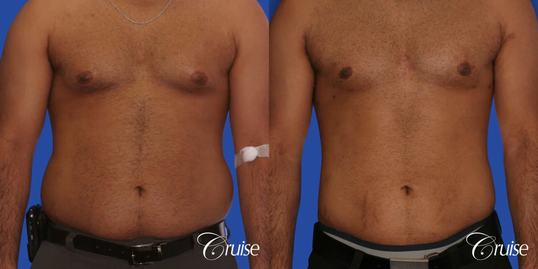 young adult with gyno gets gynecomastia surgery - Before and After 1