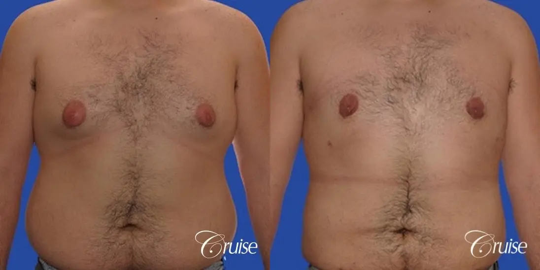 Gynecomastia with pointy nipples - Before and After 1