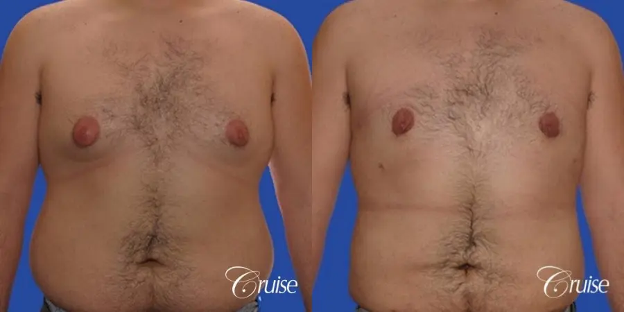 Gynecomastia with pointy nipples - Before and After 1