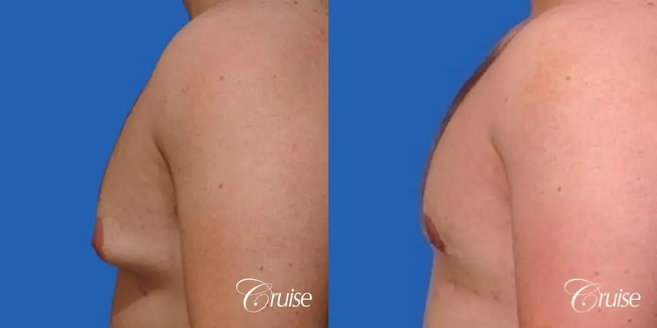mild gynecomastia with puffy nipple on adult - Before and After 2