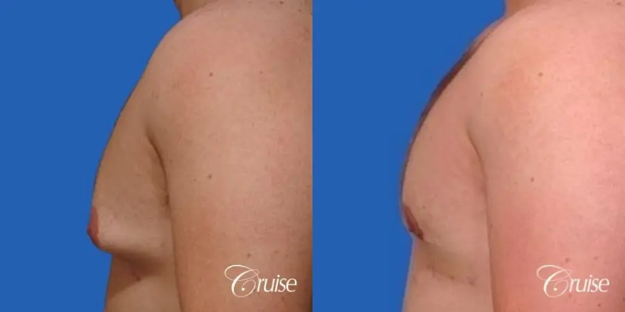 mild gynecomastia with puffy nipple on adult - Before and After 2