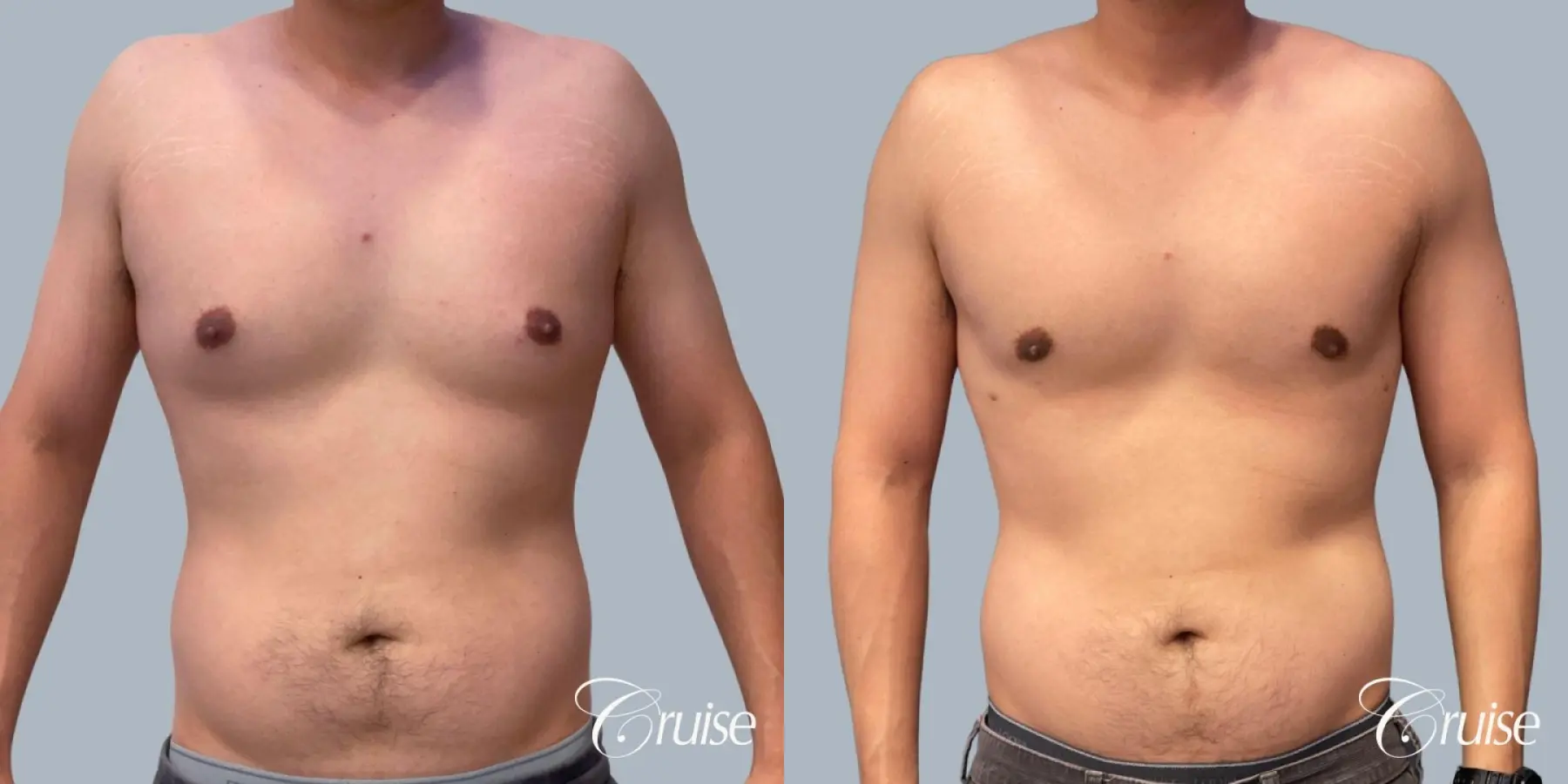 Gynecomastia: Patient 154 - Before and After 1