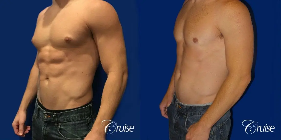 body builder puffy nipple gynecomastia - Before and After 3