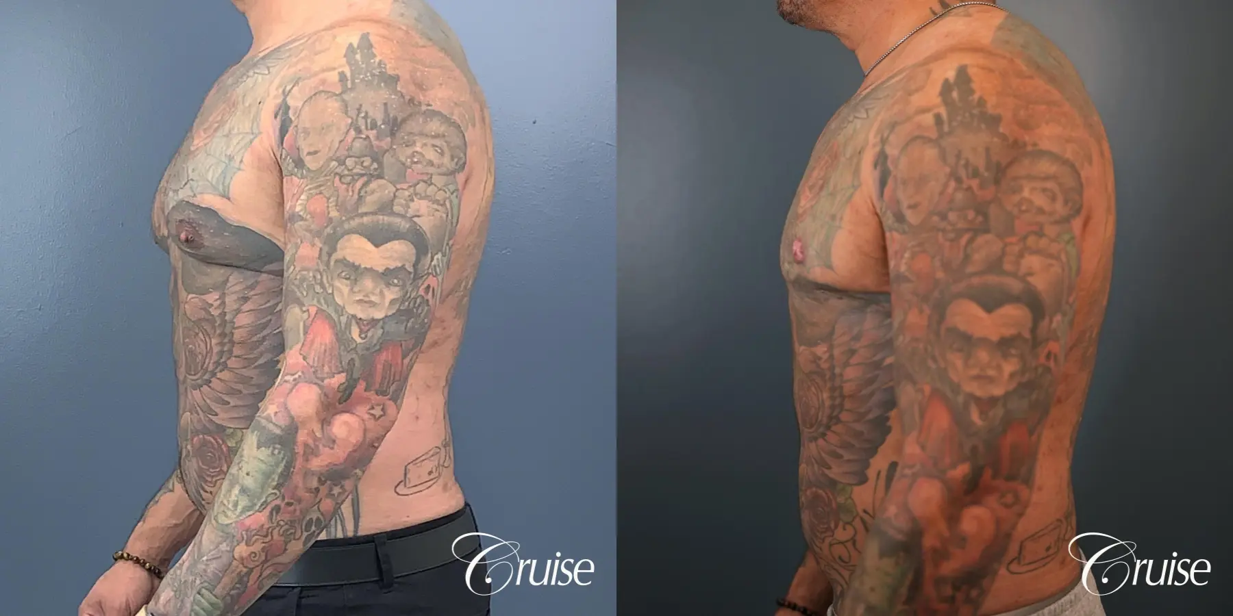 Gynecomastia: Patient 143 - Before and After 3
