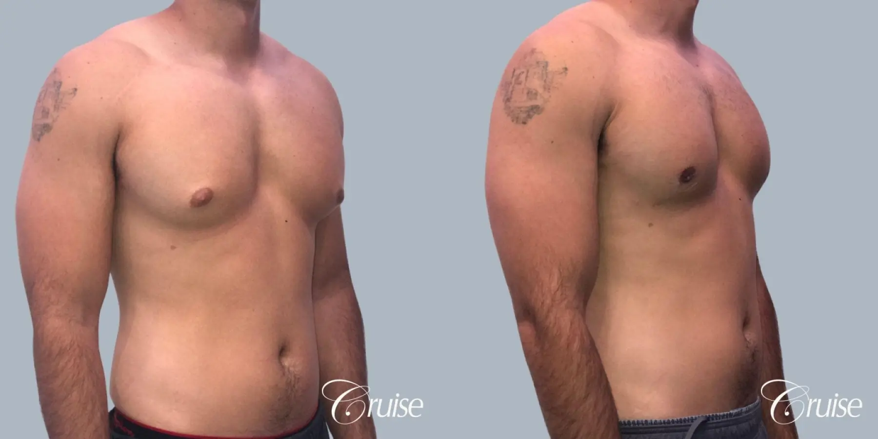 Gynecomastia: Patient 152 - Before and After 2