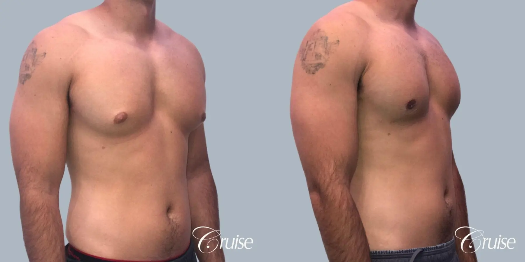 Gynecomastia: Patient 156 - Before and After 2