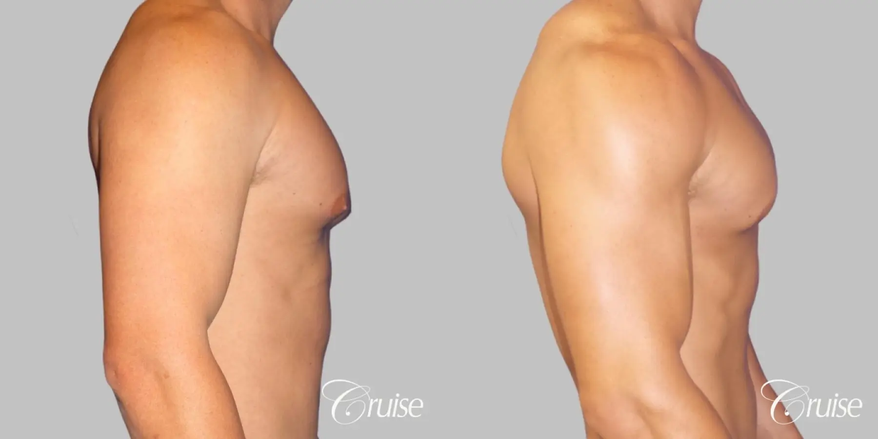 Gynecomastia puffy nipples cost - Before and After 3