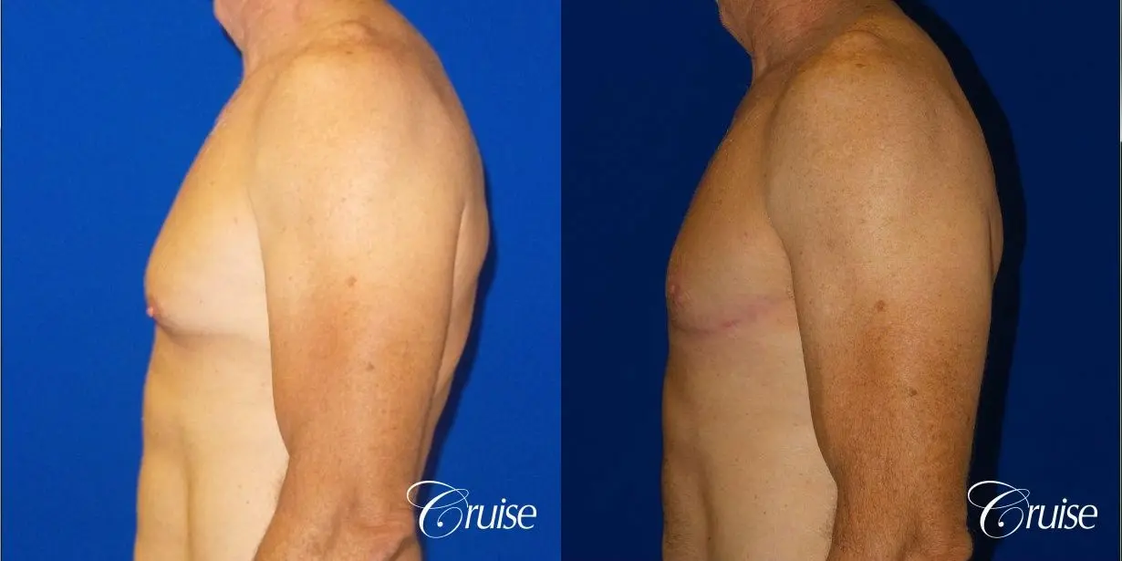 Top Gynecomastia surgeon Newport Beach - Before and After 3