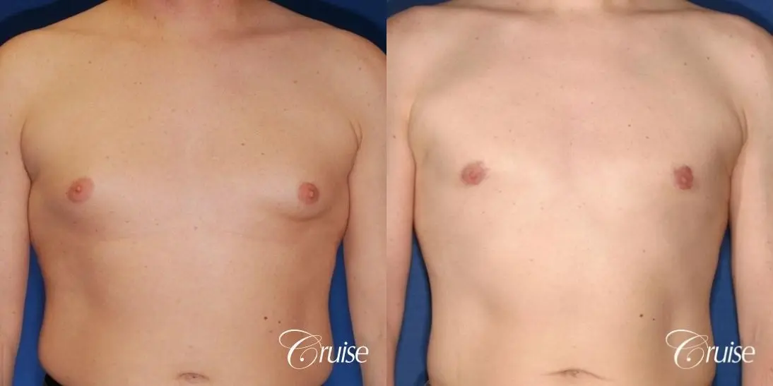 moderate gynecomastia on adult donut lift - Before and After 1