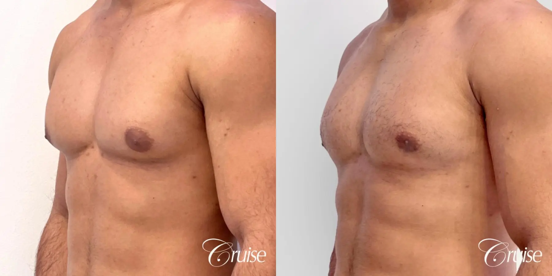 Type 1 Gynecomastia with Puffy Nipples - Before and After 2