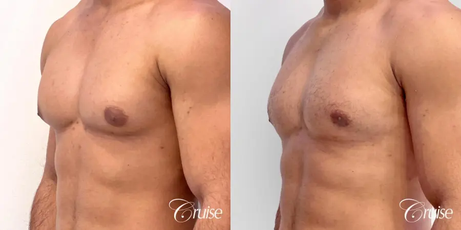 Type 1 Gynecomastia with Puffy Nipples - Before and After 2