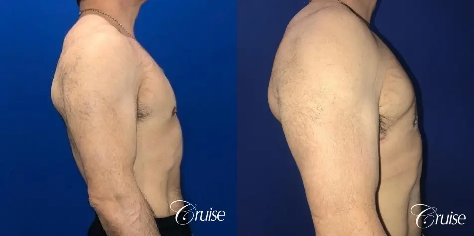 Gynecomastia: Patient 142 - Before and After 5