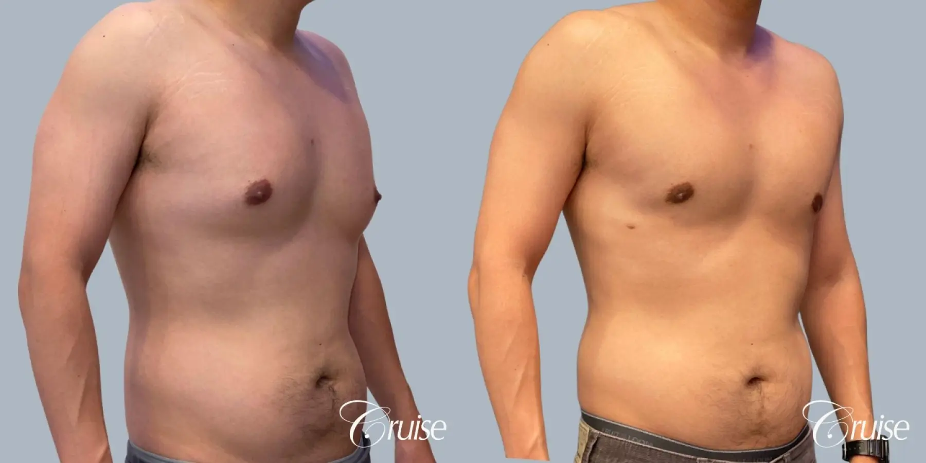 Gynecomastia: Patient 154 - Before and After 2