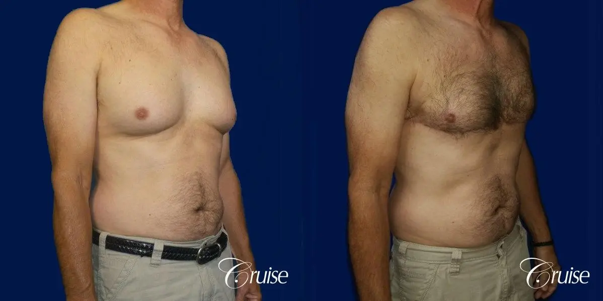 Type 4 Gynecomastia Gland Removal & Liposuction  - Before and After 4