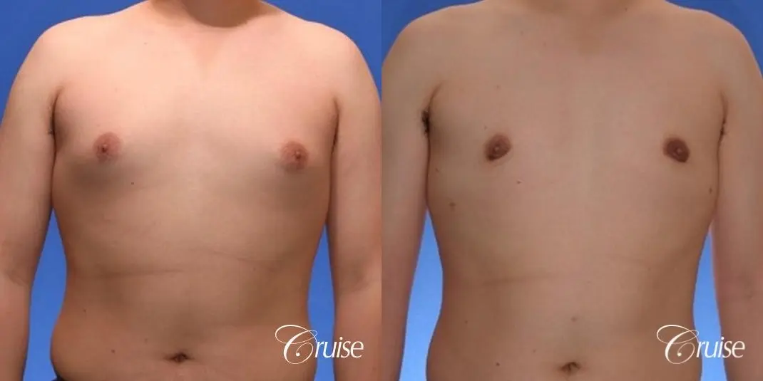 young male with mild gynecomastia surgery for puffy nipple - Before and After 1