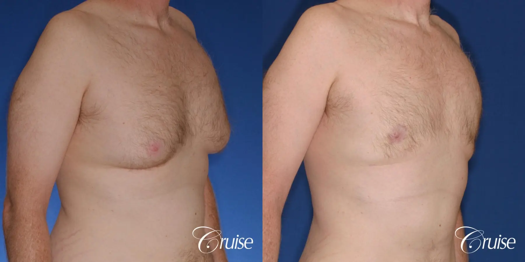 best donut lift with gynecomastia surgery - Before and After 4