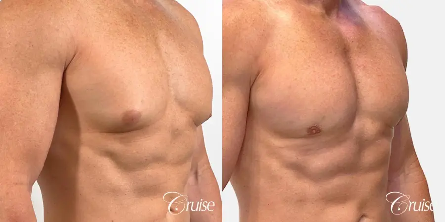 gynecomastia removal - Before and After 2