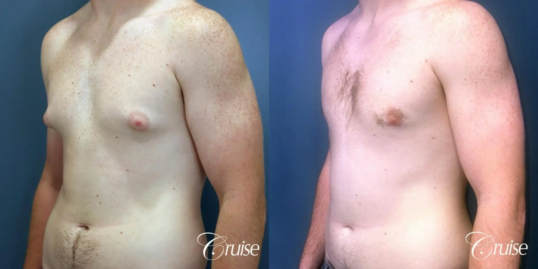 Gynecomastia: Patient 137 - Before and After 2