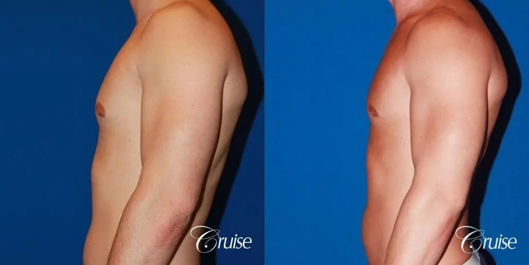 32 yo with Gynecomatia and Puffy Nipple - Before and After 2