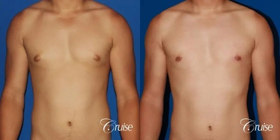 young athletic adult with puffy nipple - Before and After 1