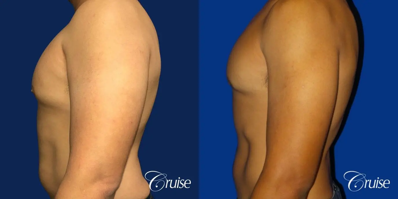 Type 2 Gynecomastia with Areola Incision - Before and After 3