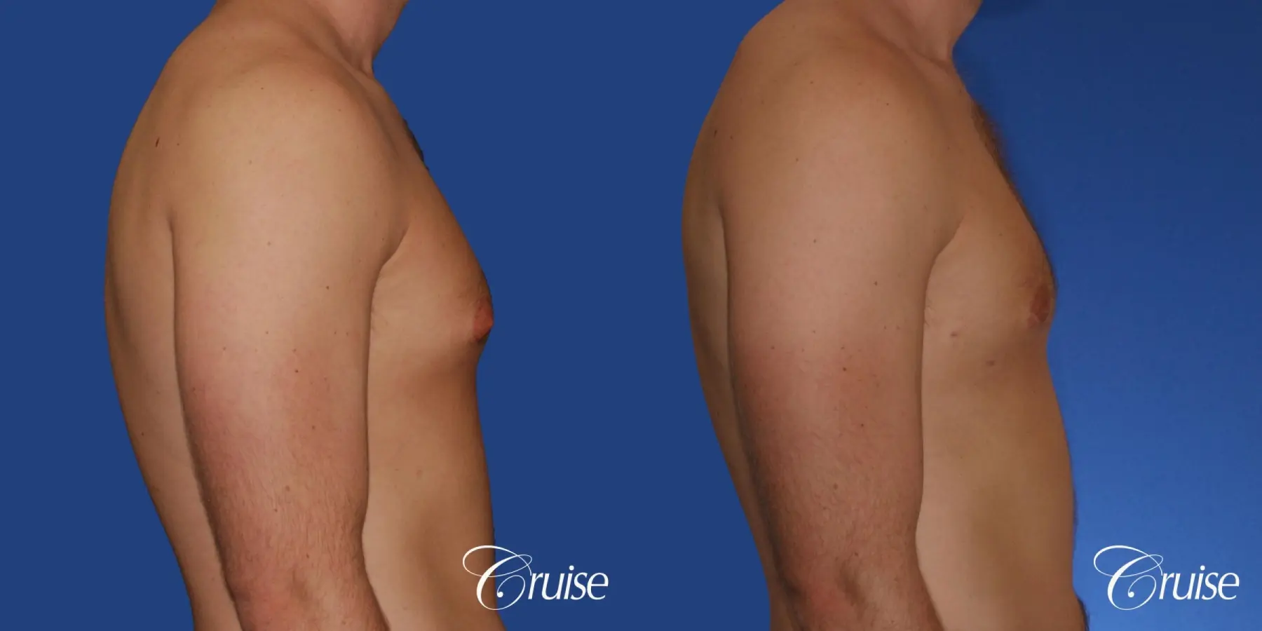 young adult with puffy nipple gets the best results with top gynecomastia surgeon - Before and After 2