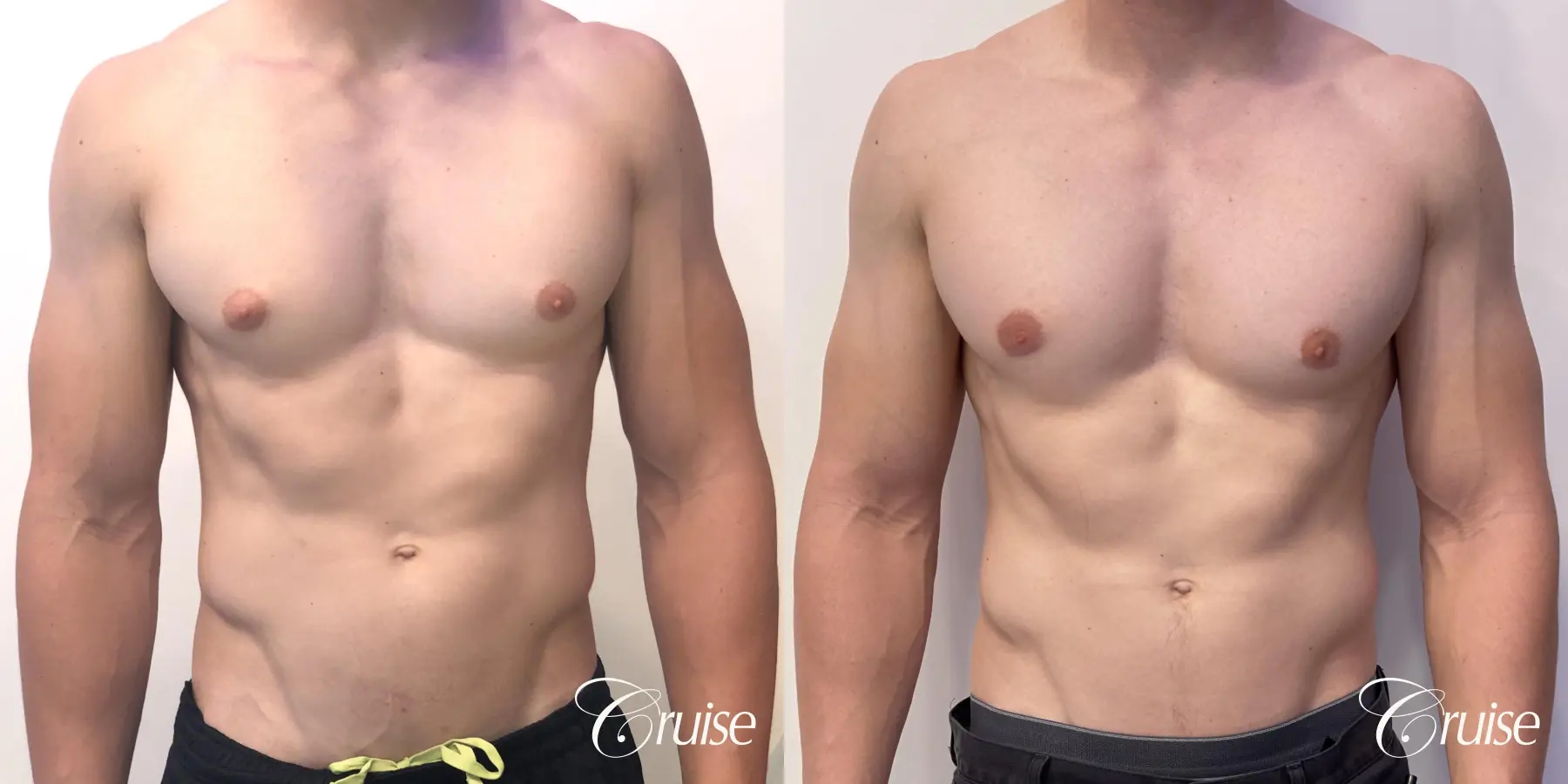 gynecomastia with puffy nipples - Before and After 1