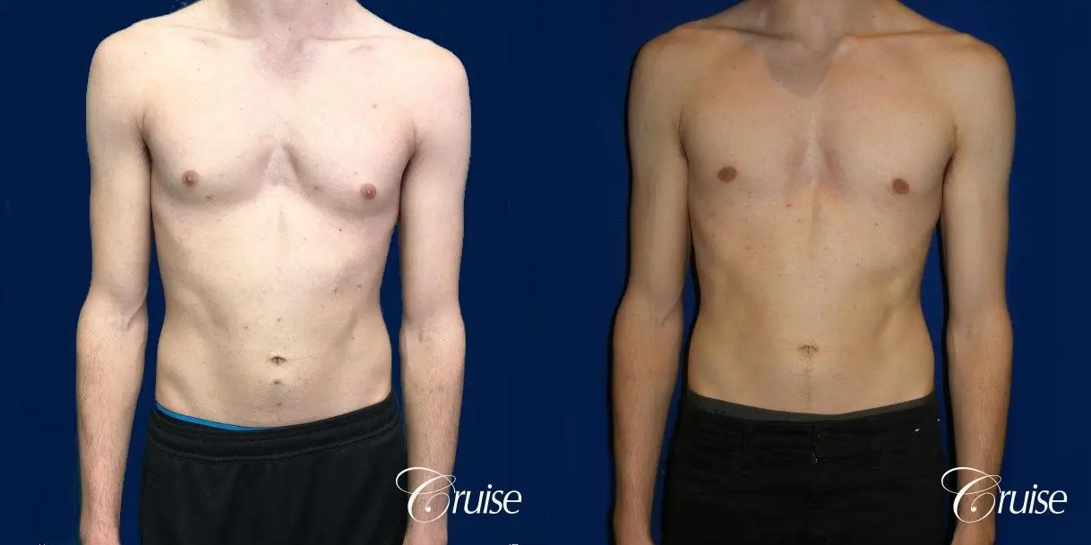 Top Gynecomastia Specialist Dr. Cruise - Before and After