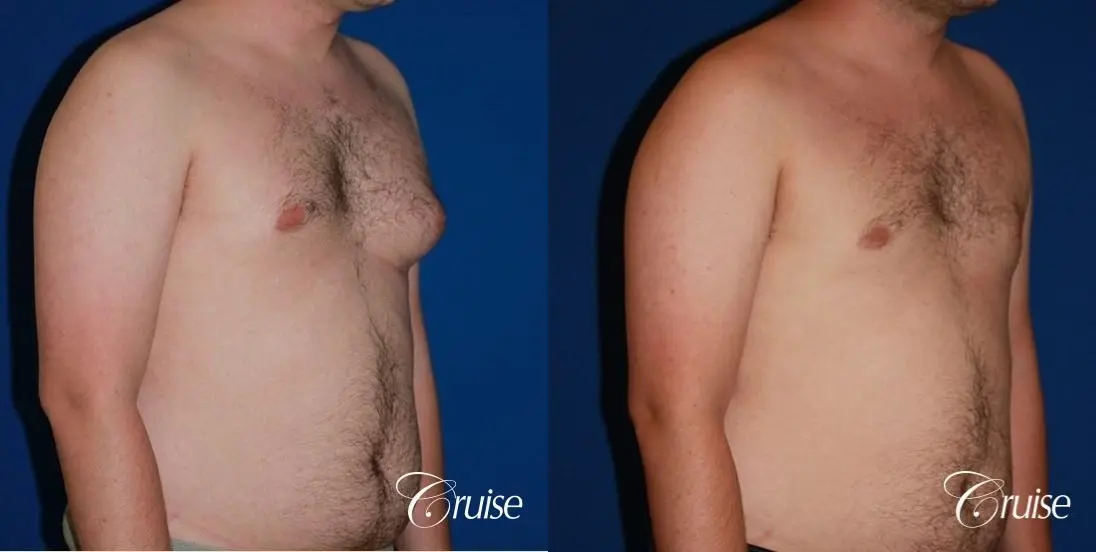 asymmetric gynecomastia moderate - Before and After 4