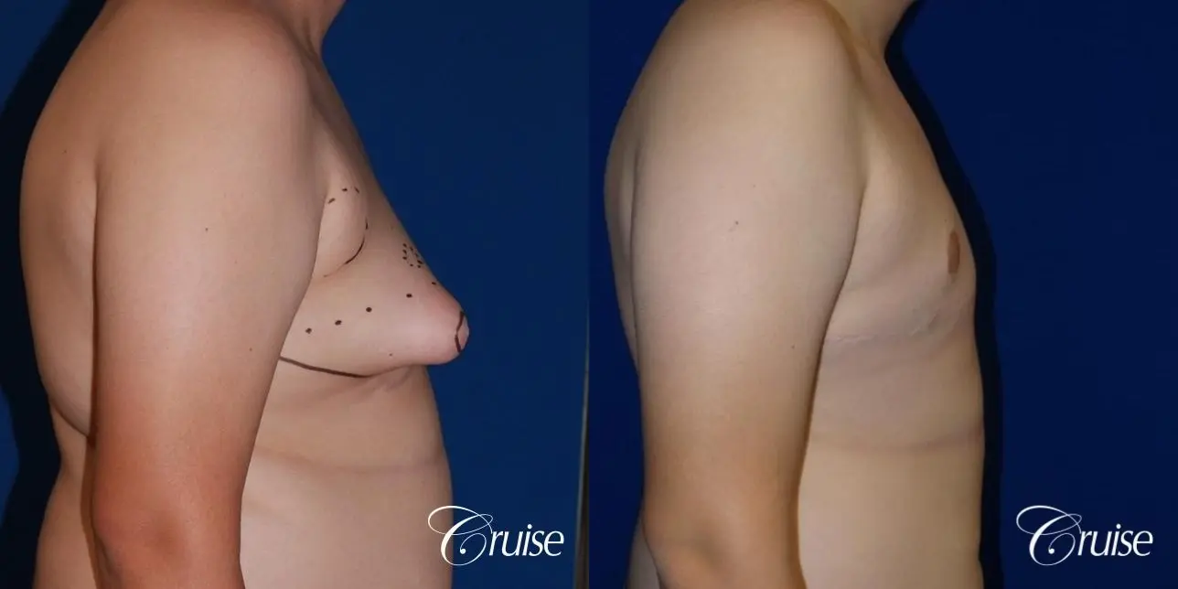 young boy with gynecomastia during puberty gets surgery - Before and After 4