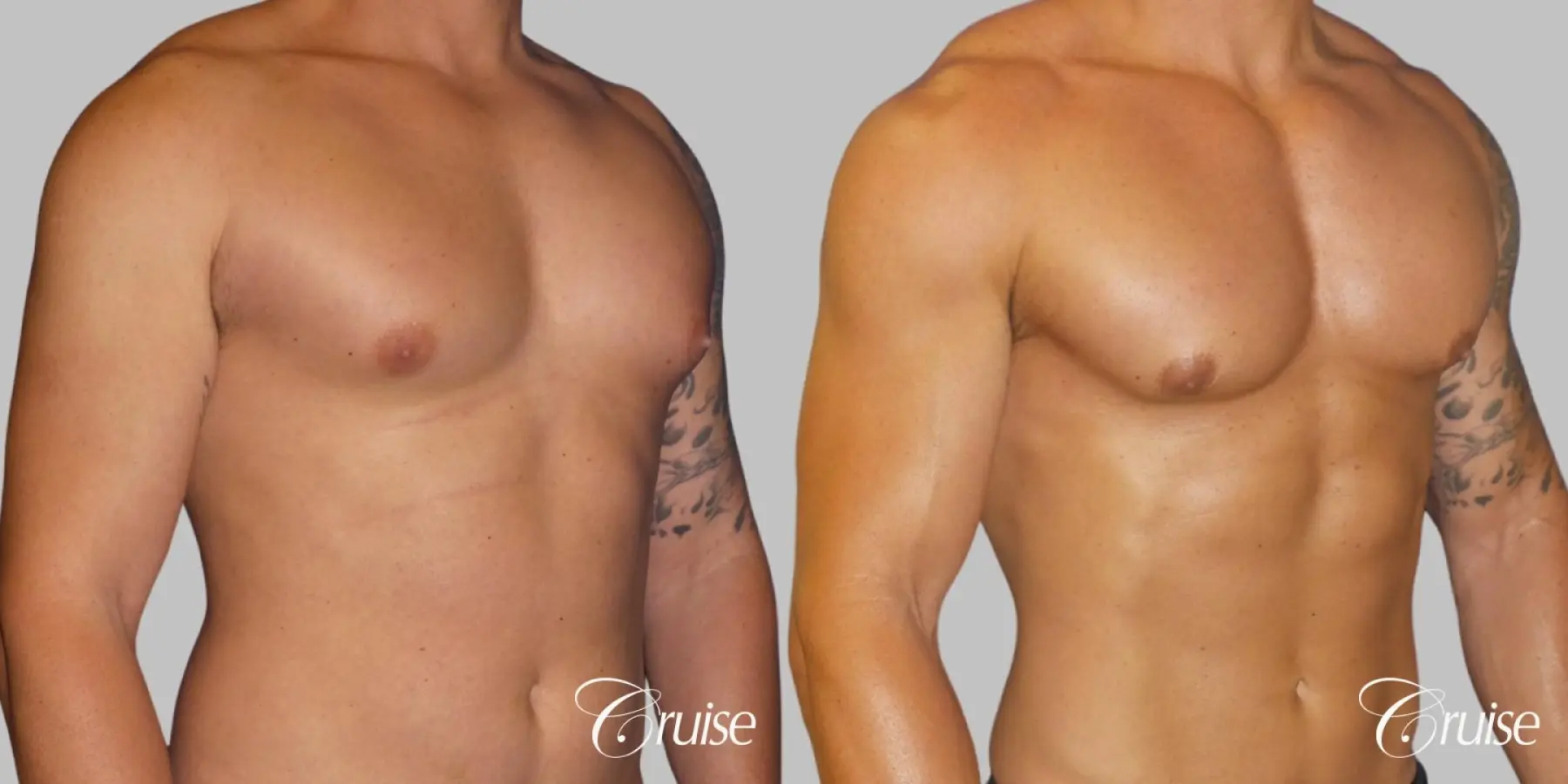 Gynecomastia puffy nipples cost - Before and After 2
